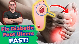 Diabetic Foot Ulcer Treatment & Early Stages [Diabetic Neuropathy]