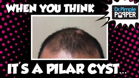Thought it was a Pilar, but it's an Epidermoid Cyst