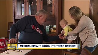 Strongsville man receives breakthrough procedure to cure tremors