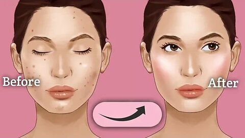 5 Steps to get a clear skin.