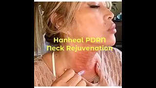 Neck Rejuvenation with Hanheal Facial Rejuvenation | marieliza10 discount code