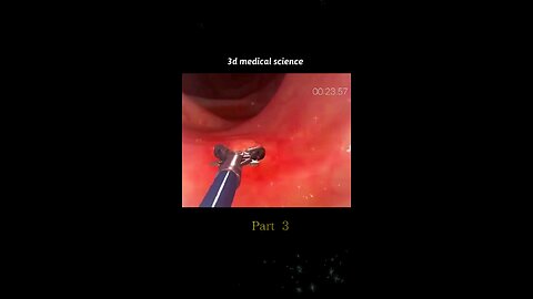 SURGICAL REMOVAL OF LUMPS