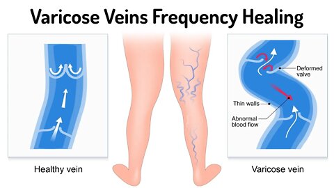 Varicose Veins Supportive Healing (Energy Healing/Frequency Music)