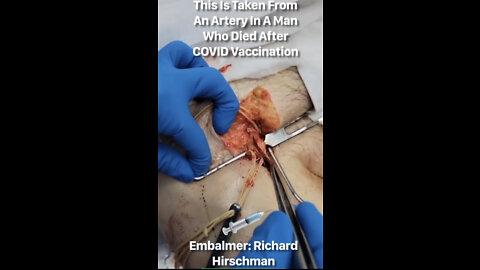 Richard Hirschman: Terrifying video of a blood clot being removed from a vaccinated person