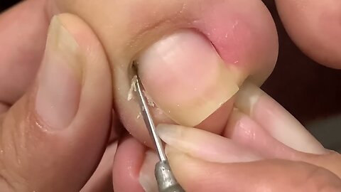PROFESSIONAL SKIN PICKING AND FEET TIGHTENING WITH A NAIL WORKER