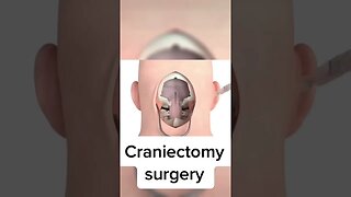 Craniectomy surgery #shorts #surgery #information