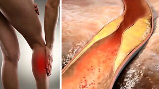 If You Feel This Kind Of Pain, You May Have High Cholesterol