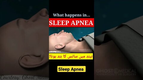 Sleep Apnea #shorts #sleep #apnea #dr