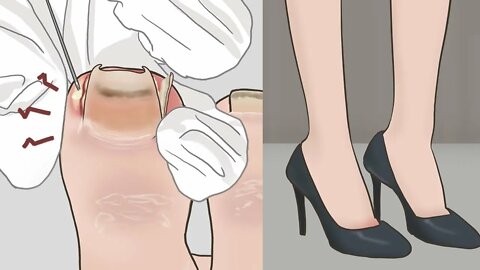 ASMR Oddly satisfying Ingrown toenail removal animation