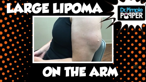 Your Lipoma Squish is On My List