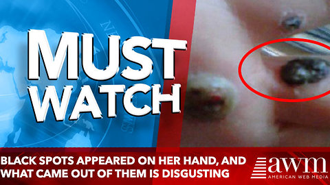 Black Spots Appeared On Her Hand, And What Came Out Of Them Is More Than Disgusting