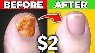 Get Rid Of Toenail Fungus for Good: Dr. Berg's $2.00 Cure