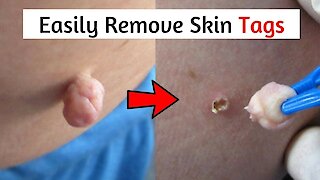 7 Easy Ways to Remove Skin Tags Without Seeing a Doctor