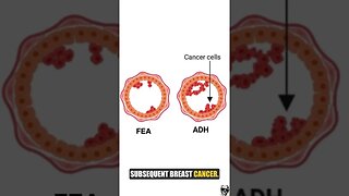 Intro to Breast Cancer