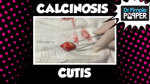 Two "Cysts" Calcinosis Cutis
