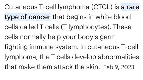 Cutaneous T-cell lymphoma (CTCL) is a rare type of cancer