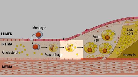 LDL CHOLESTEROL! FOAM CELLS! PLAQUE! ATHEROSCLEROSIS! EXPLAINED! #shorts #shortsvideo