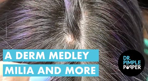 A Dermatology Medley - Milia and Beyond