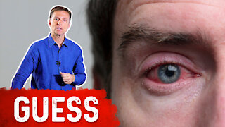 What causes bloodshot eyes?