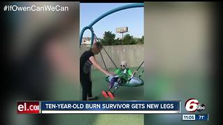 Child burn survivor gets new prosthetic legs