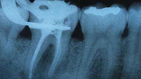 How Dental Meridians are Blocked by Root Canals by Dr. Dawn Ewing, PhD