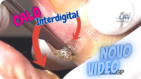 CALO interdigital, RETIRADA e debaste #unhas #pes #dor #calos #podologia #profissional