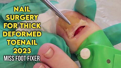 NAIL SURGERY FOR THICK DEFORMED TOENAIL 2023 BY FOOT DOCTOR MISS FOOT FIXER
