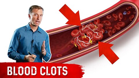 How to Know if You Have a Blood Clot