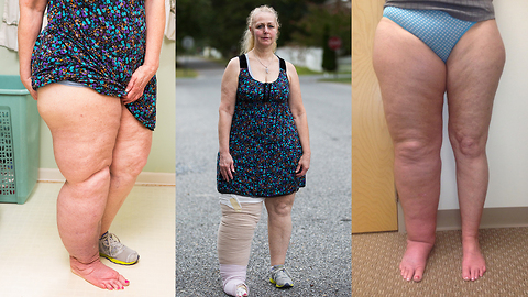 This Woman’s Leg Has Swollen Up Three Times Its Size