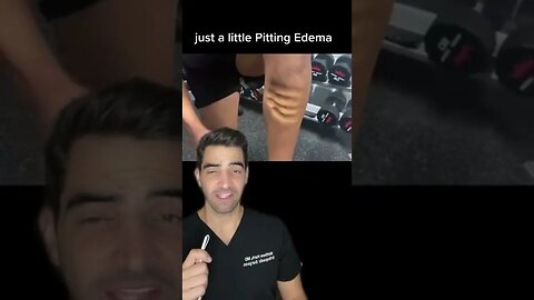 Pitting Edema - Swelling