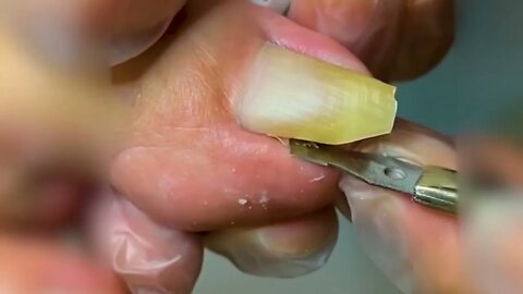 Manicure Unclogging the toenail Solve your problem #15 | 2022 Video