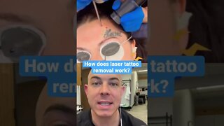 So satisfying laser tattoo removal