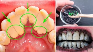 How to Remove Plaque and Tartar from Teeth at Home