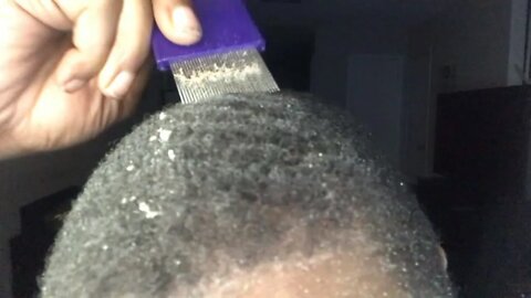 Late Night Dandruff Scratching Asmr