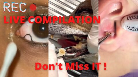 Disgusting LIVE Compilation : 1 Hour of Ingrown Hairs, Toenails, Blackheads Removal AND MORE !