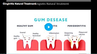 Learn about the natural treatment for gingivitis