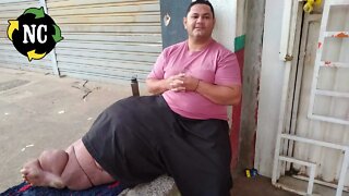 Um erro médico fez a perna deste homem chegar a pesar 81 kg. Agora ele pede ajuda para removê-la