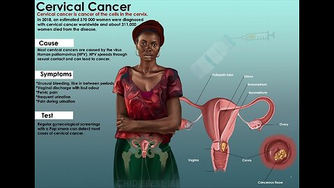 CERVICAL CANCER CAN BE SEXUALLY TRANSMITTED (HPV) : THE DAUGHTERS OF ZION, BLACK WOMEN EXPERIENCE A HIGHER MORTALITY & MORBIDITY RATE FROM CERVICAL CANCER MORE THAN OTHER ETHNIC GROUP.🕎Isaiah 1:3-9 “but Israel doth not know”