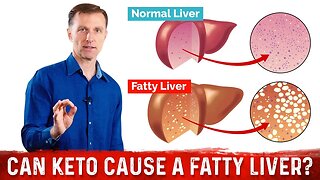 Can the Ketogenic Diet Cause a Fatty Liver Without Enough Vegetables? – Dr.Berg