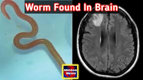 Live worm found in Australian woman's brain