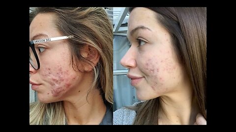 Best Treatment of Acne | Acne Scars | Pimples By Homeopathic Dr Prof Muhammad Sadique