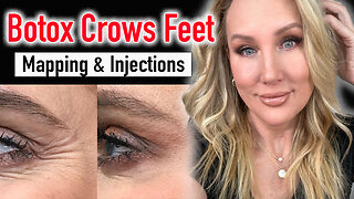 Botox Crows Feet // Full Tutorial