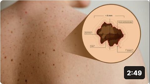 How To Tell If Your Mole is Cancerous Use This Simple ABCD Test!