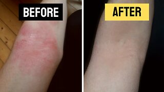 I healed my eczema... Here's how!
