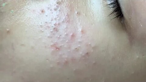 Removal / extraction of blackheads, whiteheads and pimples.