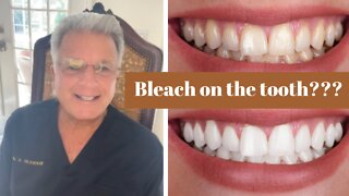 Teeth Whitening Options?