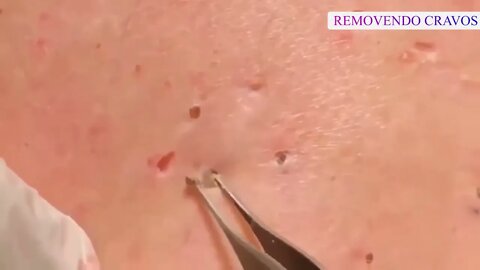 Satisfactory Video Blackhead Removal For Relaxation | 2022 Video