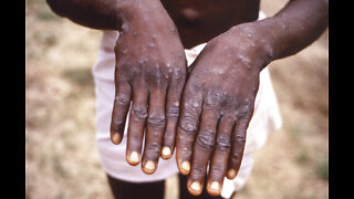 Ask Dr. Nandi: WHO confirms more cases, but says Monkeypox outbreak is containable