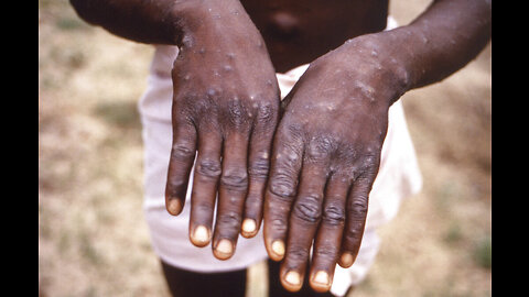 Ask Dr. Nandi: WHO confirms more cases, but says Monkeypox outbreak is containable