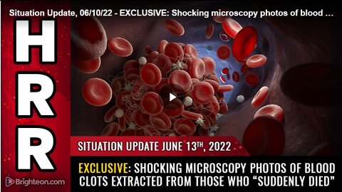 06-13-22 S.U. - Shocking Microscopy photos of Blood Clots Extracted From those Who Suddenly Died